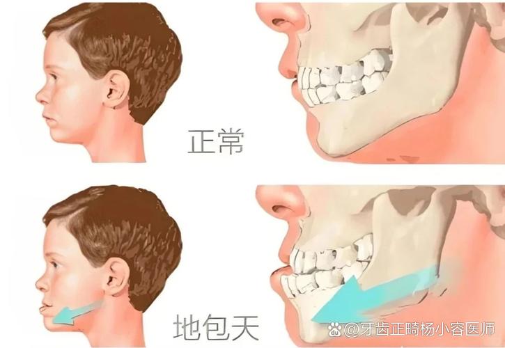 武汉12岁小孩能做牙齿矫正吗？别等换完牙才后悔