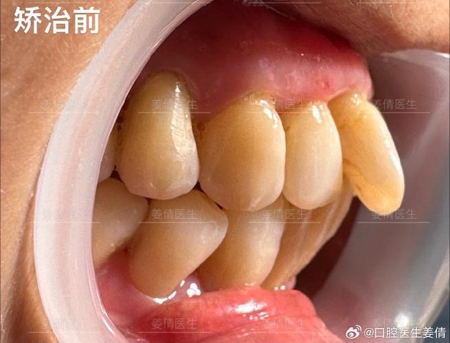 武汉60岁还能做牙齿矫正吗