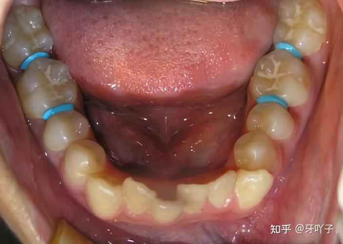武汉玉林牙齿矫正效果怎么样？看完这篇就心里有数了