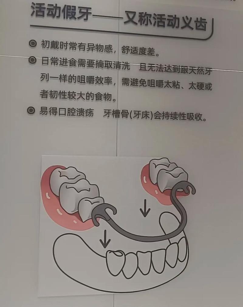 武汉活动假牙固定假牙种植牙哪个好 牙医一次说清别再被忽悠