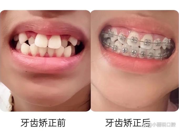 武汉15岁牙齿不齐怎么办 专家说三种矫正方式哪种最适合你