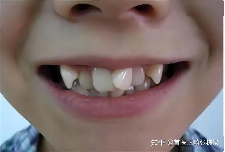 武汉深圳儿童地包天最佳矫正年龄是多少？别等换牙误了大事