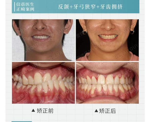 武汉深圳中学生牙齿矫正优惠活动真的靠谱吗？