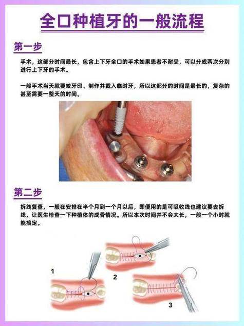武汉沈阳种植牙2026价格：单颗3000-5200元是真的吗