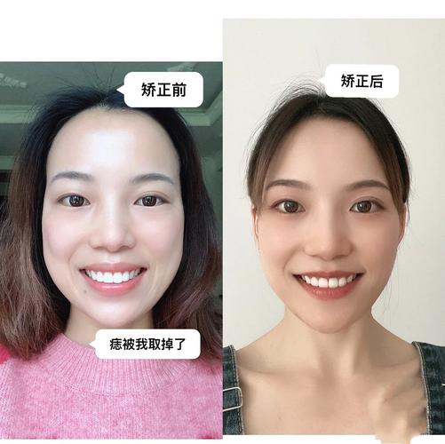 武汉成年人牙齿矫正还来得及吗
