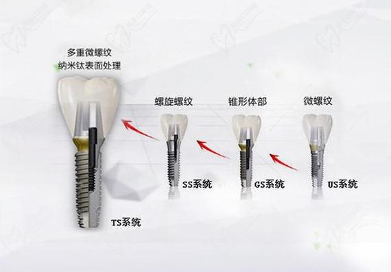 武汉唐山韩系奥齿泰种植牙2026最新费用一览