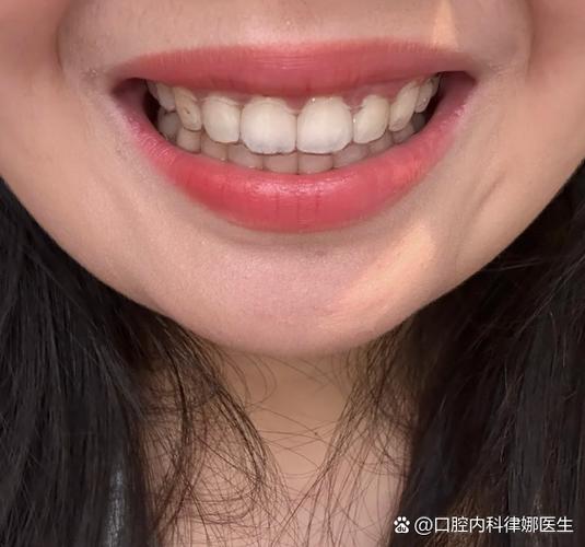 武汉23岁牙不齐还能整吗？正畸黄金期过了没