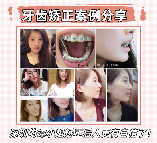 深圳牙齿正畸医院_深圳骨性龅牙正畸哪家医院靠谱_深圳正畸牙齿哪个医生好