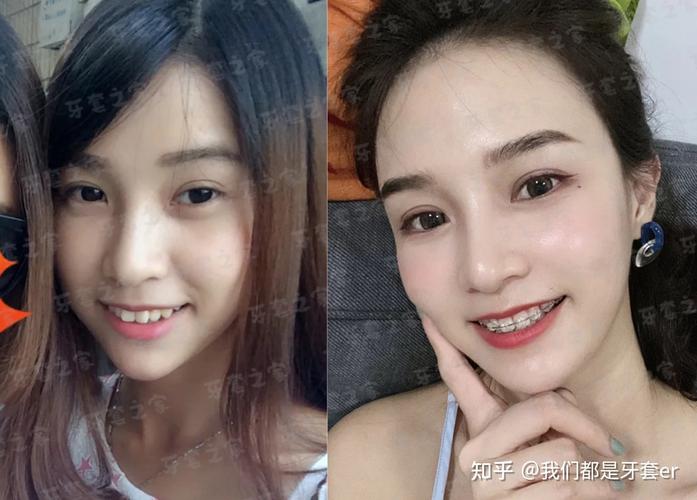 武汉43岁矫正深覆合牙齿要多少钱？从检查到摘牙套费用全掰扯清楚
