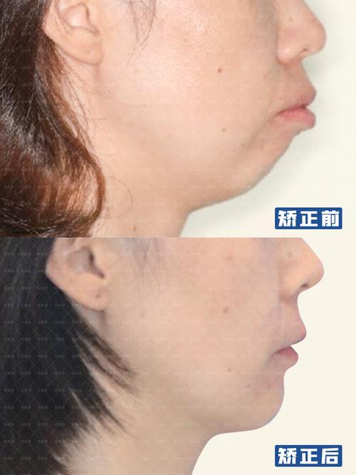 武汉矫正牙齿能改善下巴后缩吗?3个关键问题正畸医生一次说清