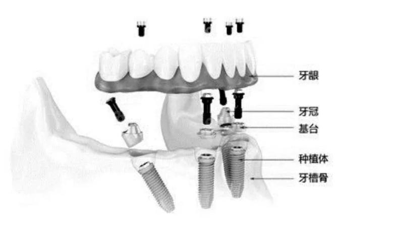 武汉半口种牙费用不固定 一颗大概多少钱