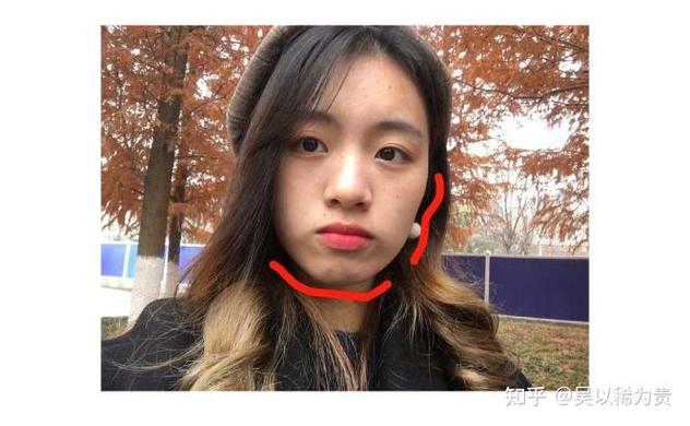 武汉莲塘小孩正畸多少钱？费用明细和避坑指南