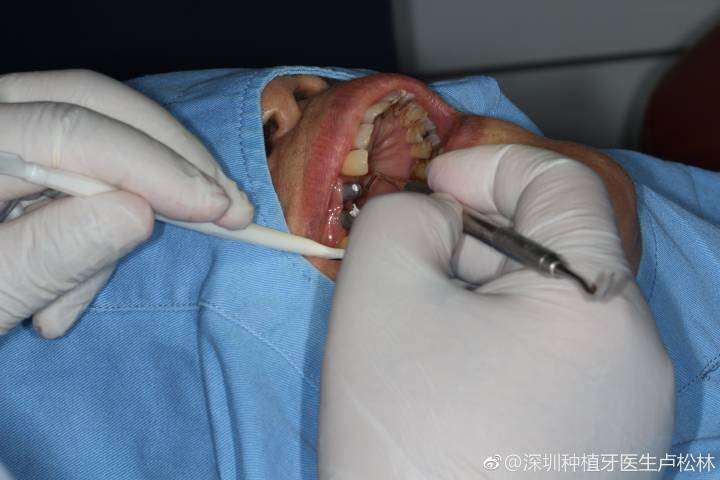 武汉80岁还能种牙吗?医生说只要满足这个条件就能做