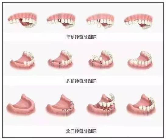 武汉半口种植牙全过程要多久?疼不疼?一步步讲清楚