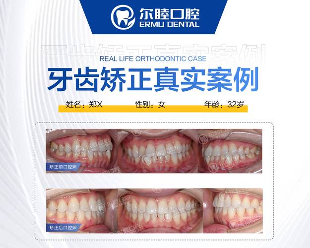 武汉成人矫正牙齿咬合疼不疼？效果和费用全解析