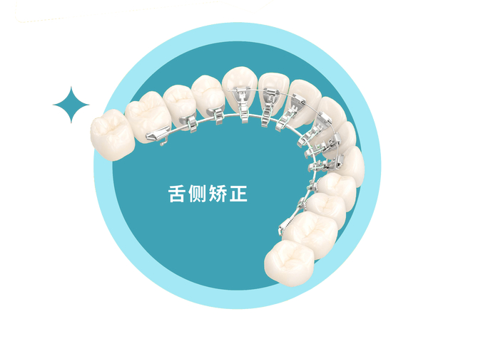 武汉成年人牙齿舌侧正畸到底值不值?看完这几点就懂了