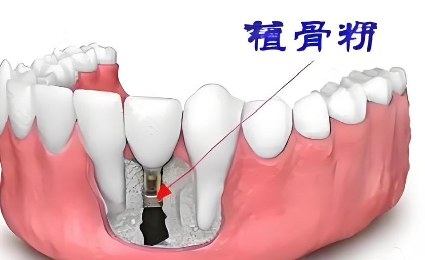 武汉5000元的种植牙靠谱吗