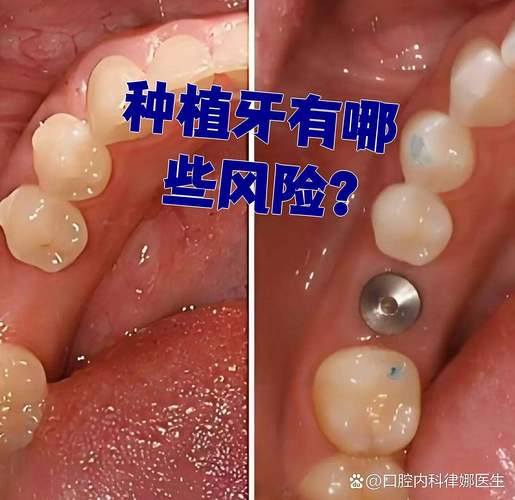 武汉全口种植牙的风险和后遗症有哪些