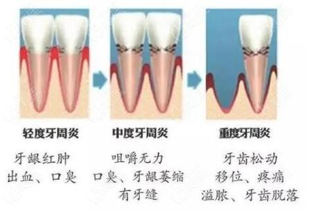武汉深圳牙周炎治疗到底要花多少钱？2026最新费用解析