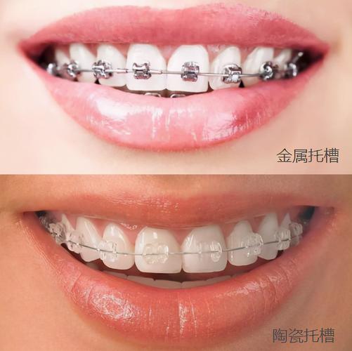 武汉深圳深覆合矫正费用大揭秘：到底多少钱才靠谱？