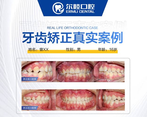 牙齿深覆合矫正器_牙齿矫正深覆合医生不管_深圳深覆合牙齿矫正多少钱