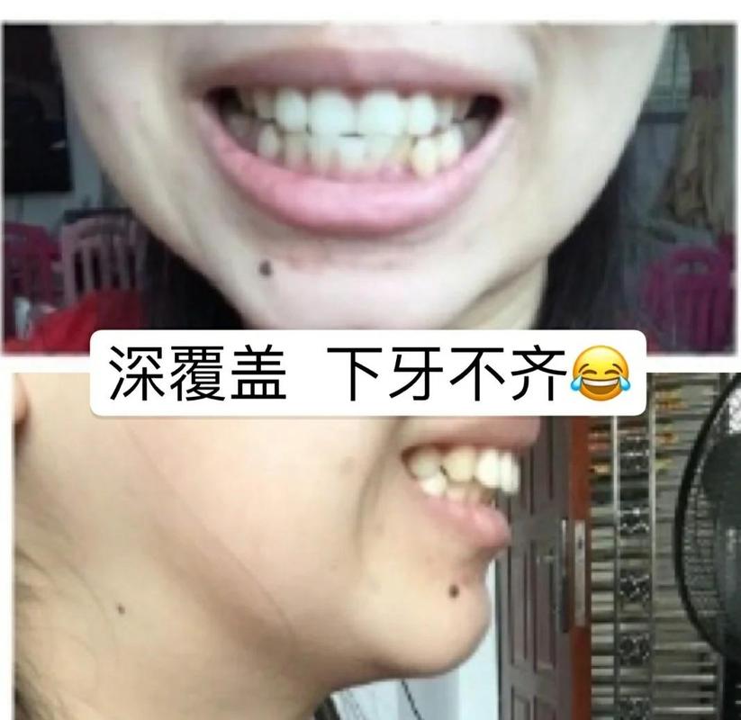 武汉39岁牙齿矫正还有用吗 真实效果看这里