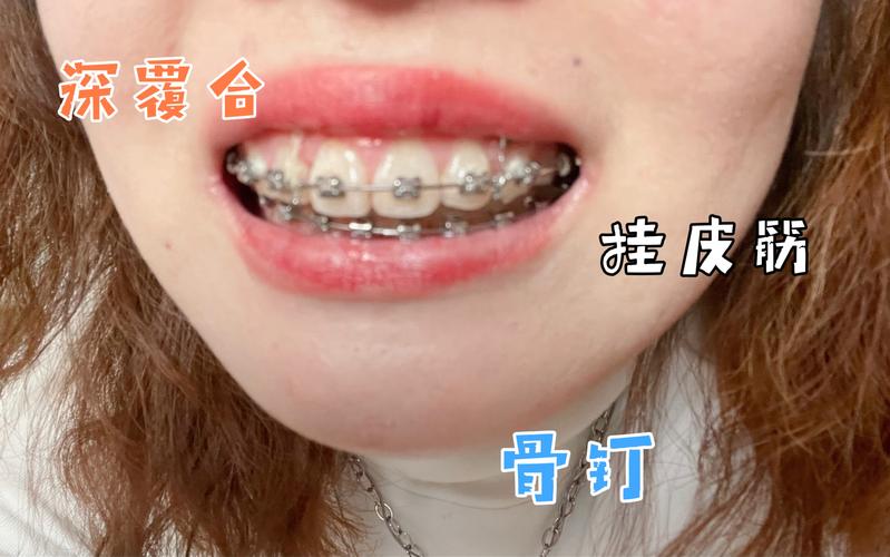 武汉深圳深覆合正畸去哪家好?牙科推荐避坑指南